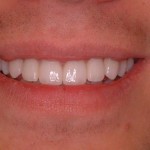 Kyle-Smile-after-tellman dentistry