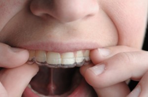 Invisinline Braces Dentist