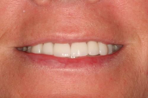 Melissa dental work by tellman dentistry