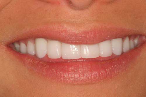 Starlas dental work by tellman dentistry